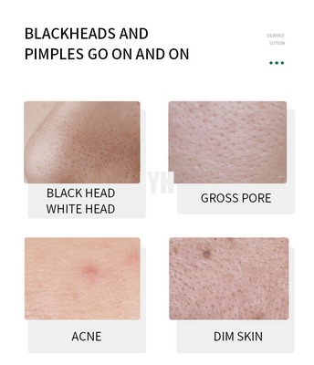 Soften Lackhead Derived Essence Yüz Serumu Siyah Nokta Giderici Serum
